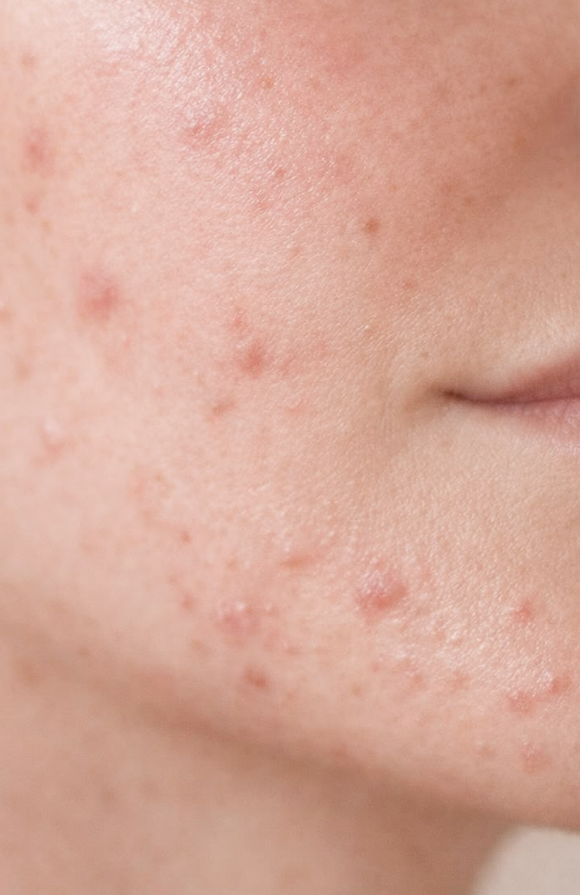 Blemish-prone skin
