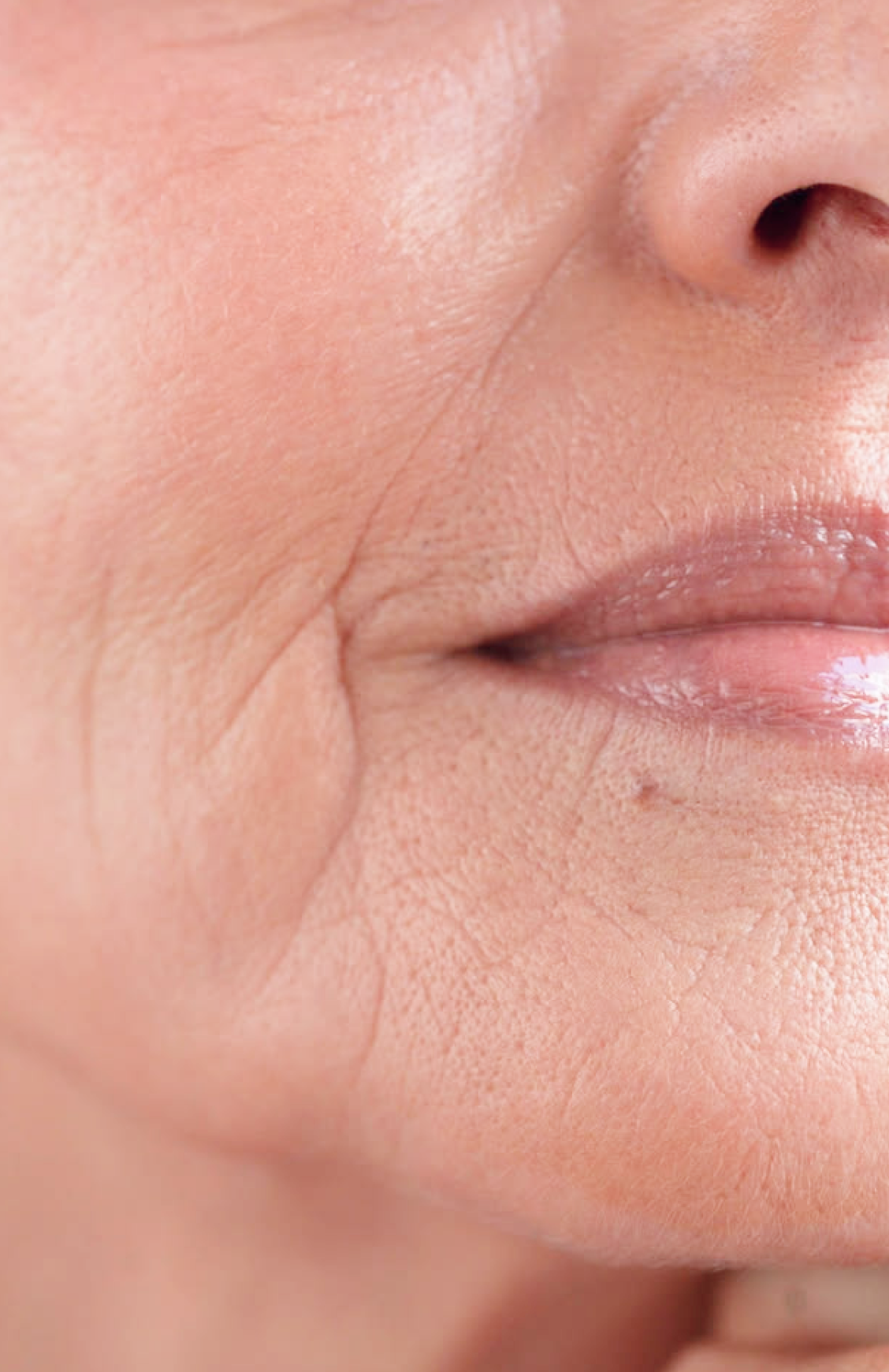 Fine lines & wrinkles