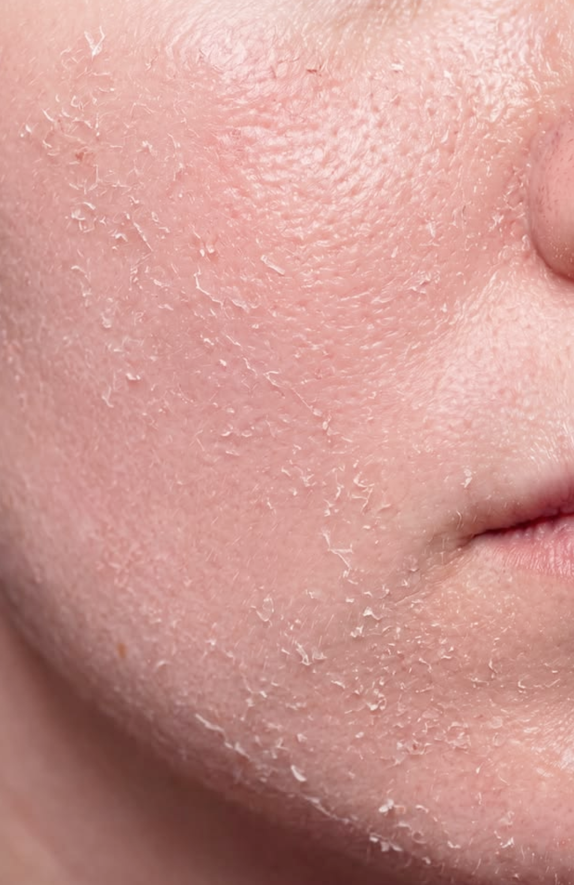 Dryness & flaking