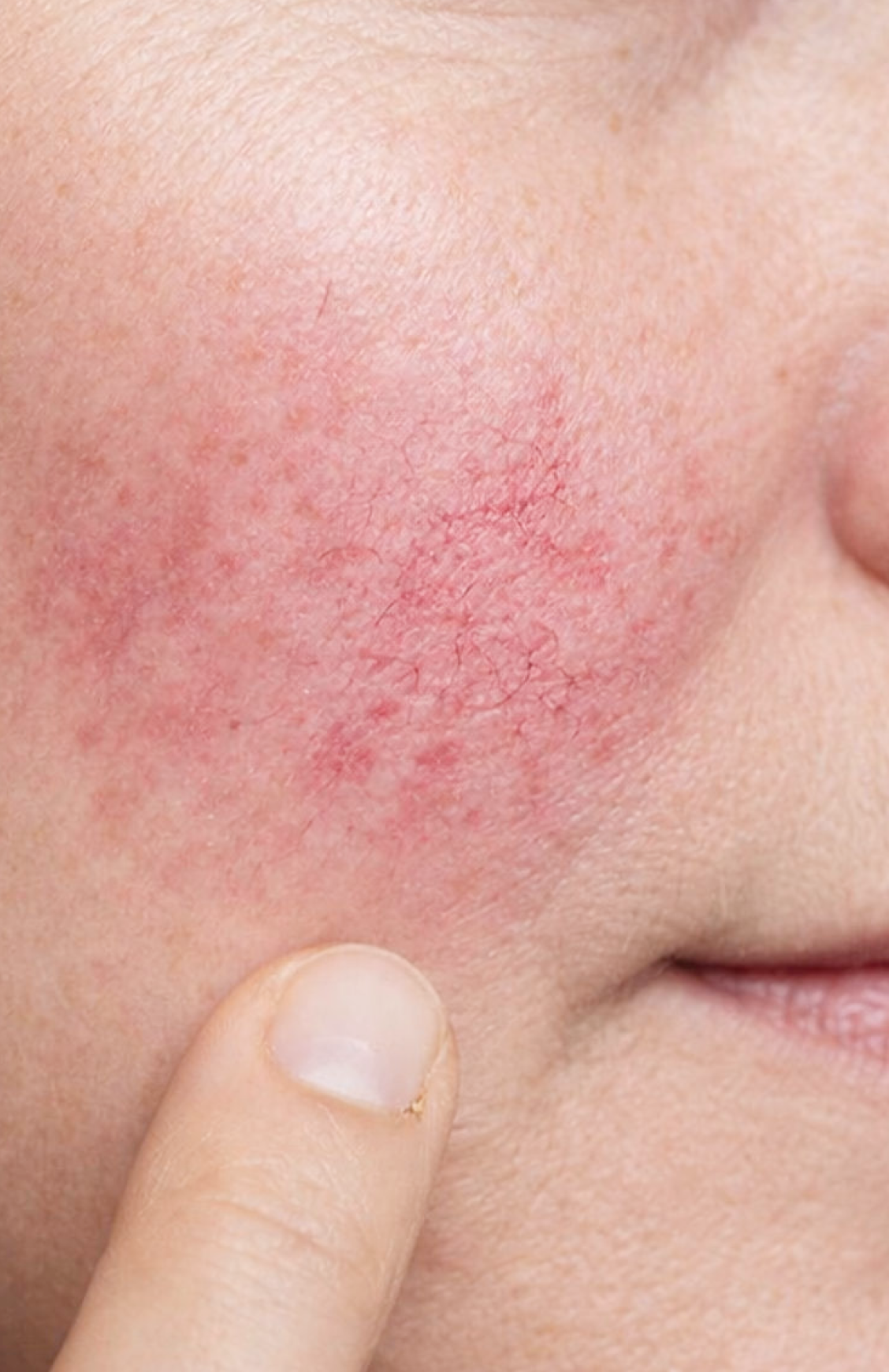 Sensitivity & visible redness